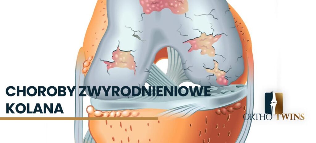 Osteotomia kolana | Osteotomia kości udowej, piszczelowej, korekcyjne