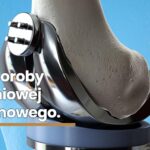 Leczenie-choroby-zwyrodnieniowej-stawu-kolanowego.