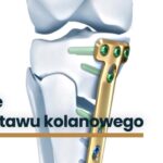 Osteotomie-w-obrębie-stawu-kolanowego