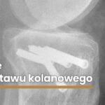 Osteotomie-w-obrębie-stawu-kolanowego2