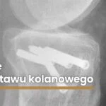 Osteotomie-w-obrębie-stawu-kolanowego2