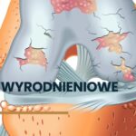 CHOROBY-ZWYRODNIENIOWE-KOLANA