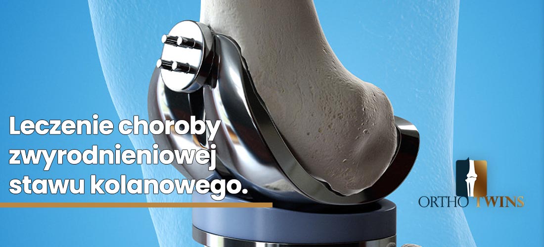 Leczenie-choroby-zwyrodnieniowej-stawu-kolanowego.