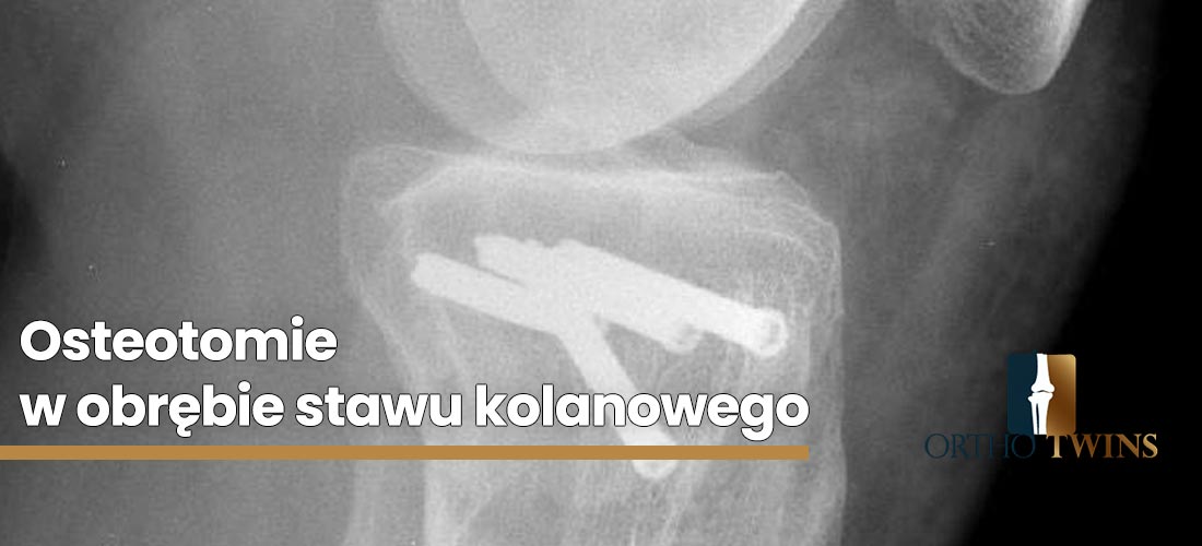 Osteotomie-w-obrębie-stawu-kolanowego2