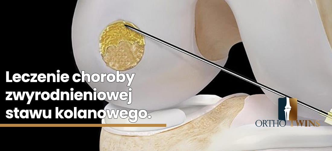 Zabiegi-naprawcze-na-chrząstce-stawowej